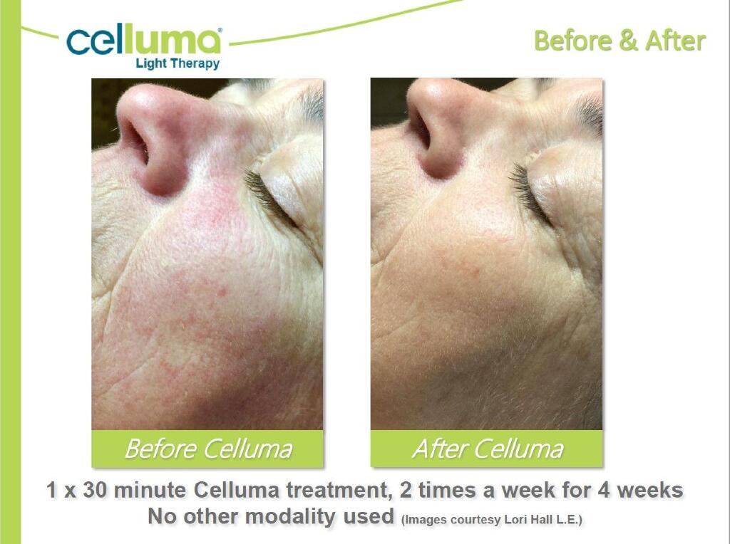 Celluma before and after anti aging LED light therapy new age