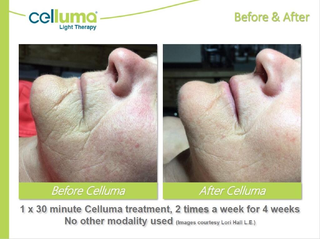 Celluma before and after anti aging LED light therapy new age